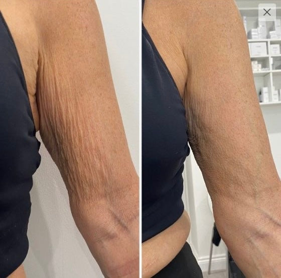 Fat Cavitation sessions! Tummy /legs /thighs/arms(standard price)