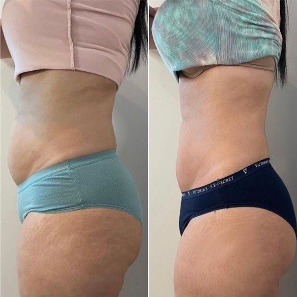 Fat Cavitation sessions! Tummy /legs /thighs/arms(standard price)