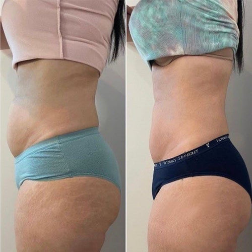 Fat Cavitation sessions! Tummy /legs /thighs/arms(standard price)